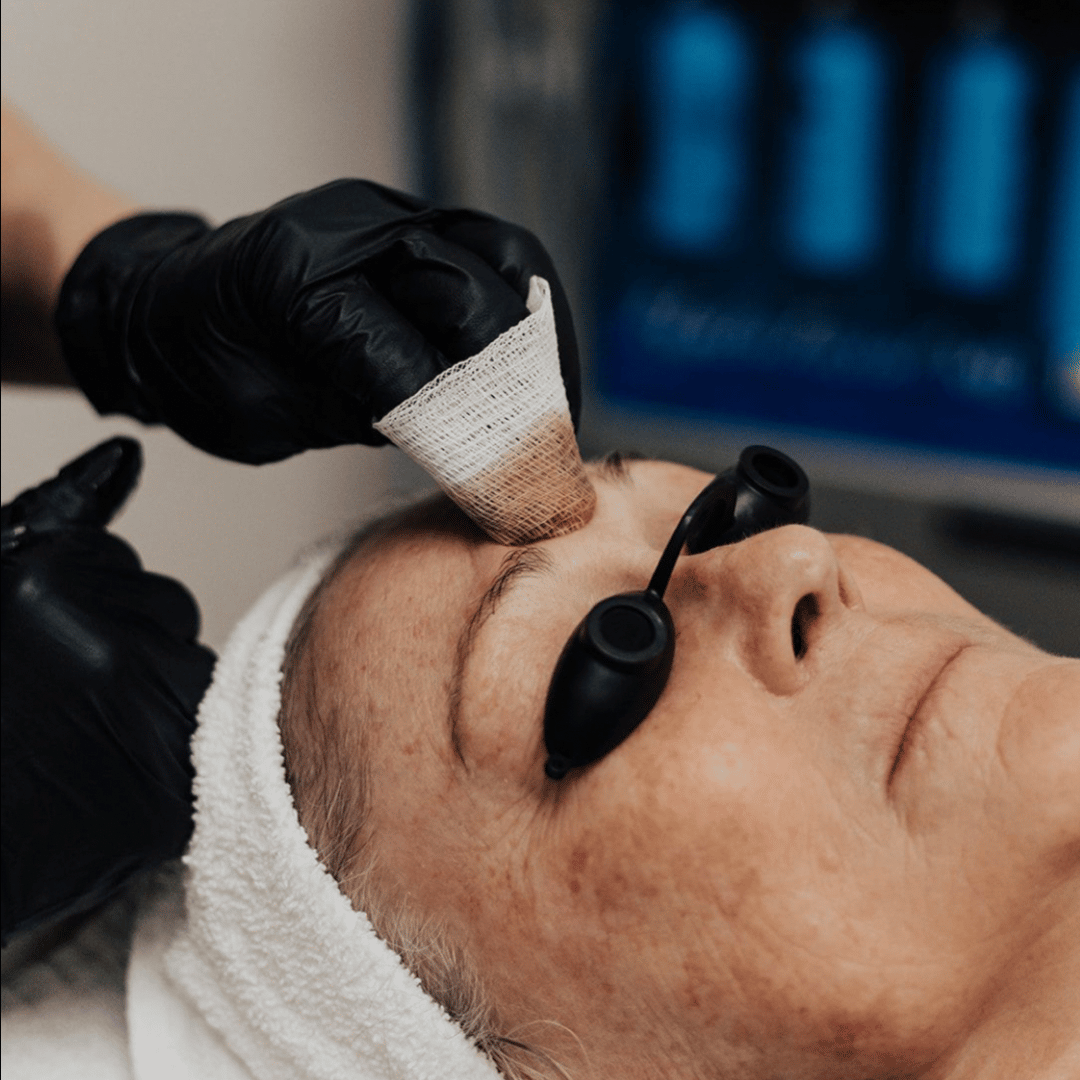 UFP-Laser-Treatment