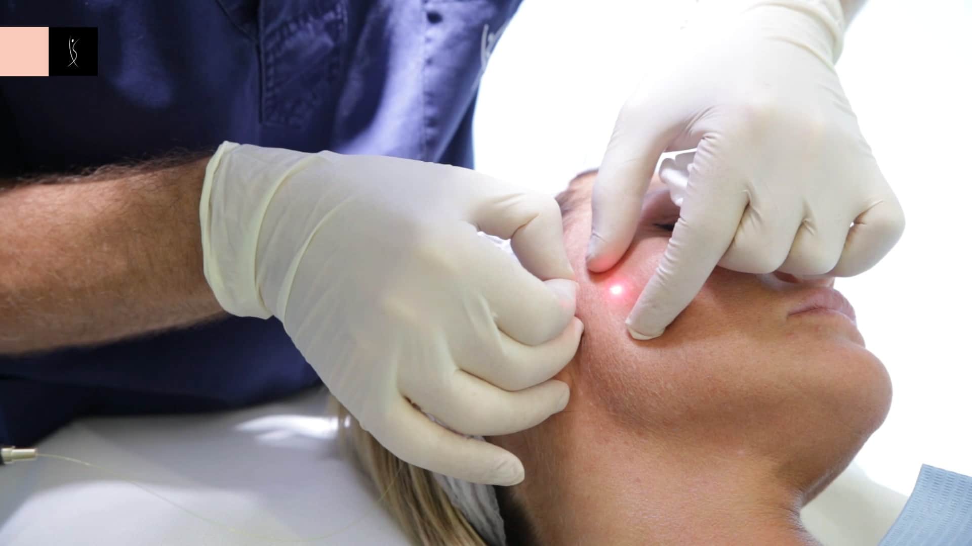 endolift-procedures